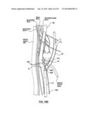 Devices and Systems for Carotid Body Ablation diagram and image