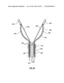 Devices and Systems for Carotid Body Ablation diagram and image