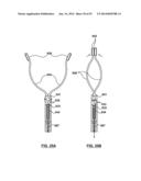 Devices and Systems for Carotid Body Ablation diagram and image