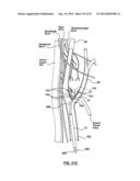 Devices and Systems for Carotid Body Ablation diagram and image