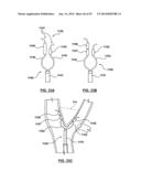 Devices and Systems for Carotid Body Ablation diagram and image