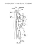 Devices and Systems for Carotid Body Ablation diagram and image