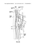 Devices and Systems for Carotid Body Ablation diagram and image