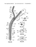 Devices and Systems for Carotid Body Ablation diagram and image