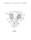 Devices and Systems for Carotid Body Ablation diagram and image