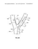 Devices and Systems for Carotid Body Ablation diagram and image