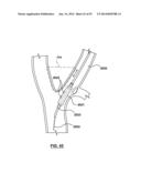 Devices and Systems for Carotid Body Ablation diagram and image