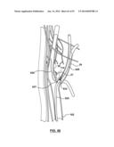 Devices and Systems for Carotid Body Ablation diagram and image