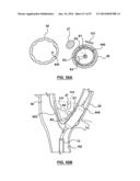 Devices and Systems for Carotid Body Ablation diagram and image