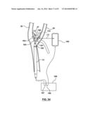 Devices and Systems for Carotid Body Ablation diagram and image