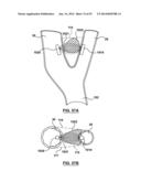 Devices and Systems for Carotid Body Ablation diagram and image