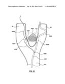 Devices and Systems for Carotid Body Ablation diagram and image