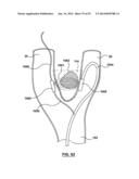 Devices and Systems for Carotid Body Ablation diagram and image