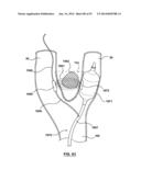 Devices and Systems for Carotid Body Ablation diagram and image