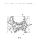 Devices and Systems for Carotid Body Ablation diagram and image