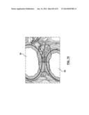 Devices and Systems for Carotid Body Ablation diagram and image