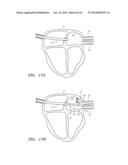 PRESHAPED LOCALIZATION CATHETER, SYSTEM, AND METHOD FOR GRAPHICALLY     RECONSTRUCTING PULMONARY VEIN OSTIA diagram and image