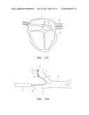 PRESHAPED LOCALIZATION CATHETER, SYSTEM, AND METHOD FOR GRAPHICALLY     RECONSTRUCTING PULMONARY VEIN OSTIA diagram and image