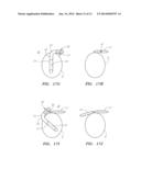 PRESHAPED LOCALIZATION CATHETER, SYSTEM, AND METHOD FOR GRAPHICALLY     RECONSTRUCTING PULMONARY VEIN OSTIA diagram and image