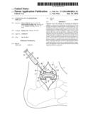 CEMENTING OF AN ORTHOPEDIC IMPLANT diagram and image