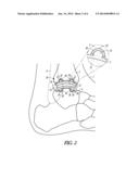 CEMENTING OF AN ORTHOPEDIC IMPLANT diagram and image