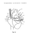 ATRIAL APPENDAGE OCCLUSION SYSTEMS AND METHODS OF USING THE SAME diagram and image