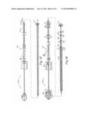 Screw Catch Mechanism for PFO Occluder and Method of Use diagram and image