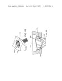 VARIABLE ANGLE BONE FIXATION DEVICE diagram and image