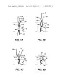 FLIPPING-TYPE GRAFT FIXATION DEVICE AND METHOD diagram and image