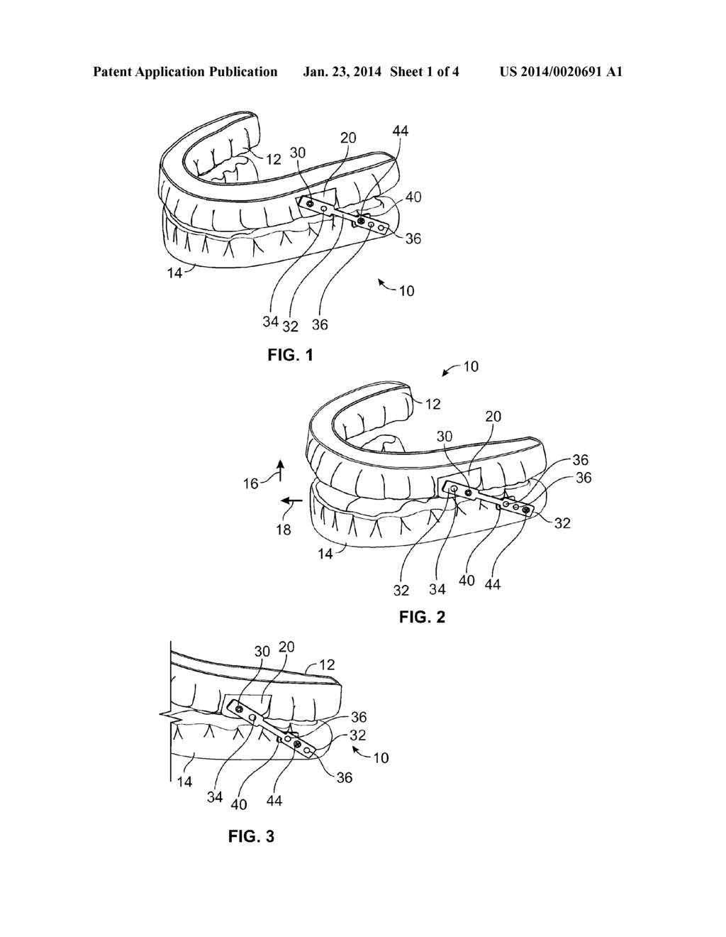 ORAL APPLIANCE FOR TREATMENT OF MEDICAL CONDITIONS SUCH AS OBSTRUCTIVE     SLEEP APNEA AND SNORING AND FOR IMPROVING ATHLETIC PERFORMANCE AND METHOD     OF OPTIMIZING SAME - diagram, schematic, and image 02