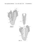 SELF-OSTEOTOMIZING BONE IMPLANT AND RELATED METHOD diagram and image