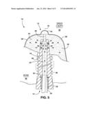 Dental Implant and Method of Use with Improved Maxillary Stability diagram and image