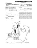 POROUS METAL DENTAL IMPLANT diagram and image