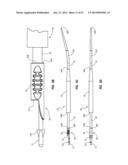 Solid-Body Catheter Including Lateral Distal Openings diagram and image