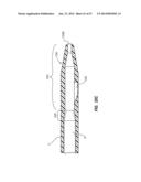 Solid-Body Catheter Including Lateral Distal Openings diagram and image