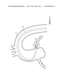 GUIDE EXTENSION CATHETER diagram and image