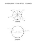 REMOVABLE DEPLOYMENT DEVICE, SYSTEM, AND METHOD FOR IMPLANTABLE PROSTHESES diagram and image