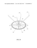 REMOVABLE DEPLOYMENT DEVICE, SYSTEM, AND METHOD FOR IMPLANTABLE PROSTHESES diagram and image