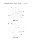 REMOVABLE DEPLOYMENT DEVICE, SYSTEM, AND METHOD FOR IMPLANTABLE PROSTHESES diagram and image