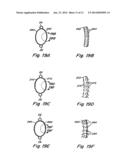 DOUBLE SPIRAL PATENT FORAMEN OVALE CLOSURE CLAMP diagram and image