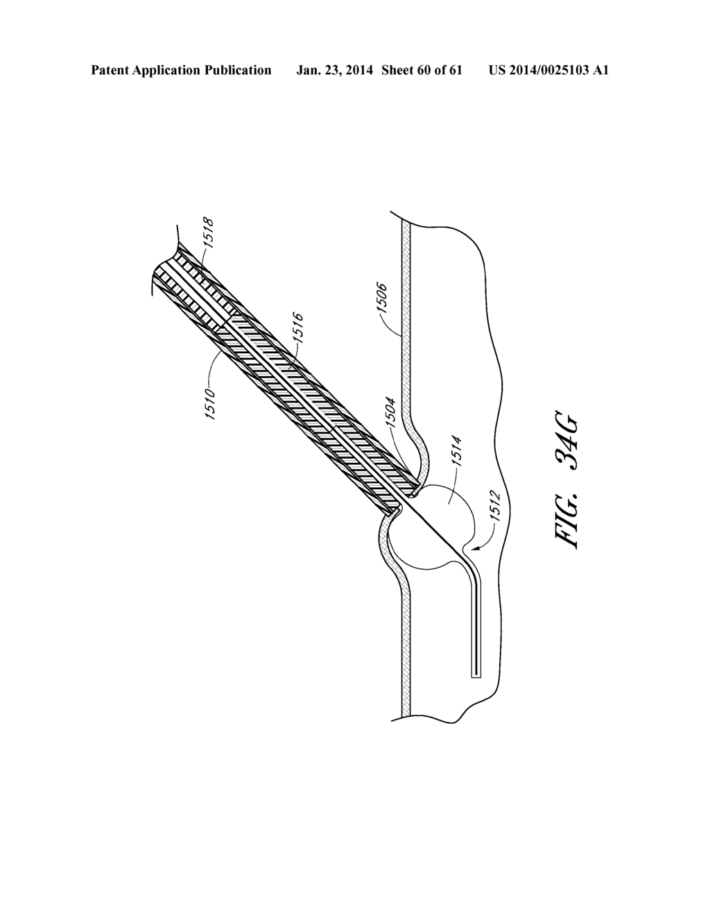 APPARATUS AND METHODS FOR SEALING A VASCULAR PUNCTURE - diagram, schematic, and image 61