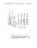 METACARPAL BONE STABILIZATION DEVICE diagram and image