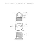 Ankle Fusion Device, Instrumentation and Methods diagram and image