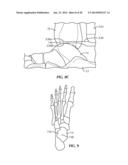 Ankle Fusion Device, Instrumentation and Methods diagram and image