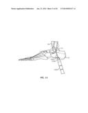 Ankle Fusion Device, Instrumentation and Methods diagram and image