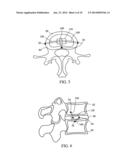 DEVICES AND METHODS FOR STABILIZING TISSUE AND IMPLANTS diagram and image