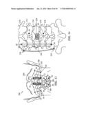 DEVICES AND METHODS FOR STABILIZING TISSUE AND IMPLANTS diagram and image