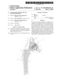 Interlocking Reverese Hip and Revision Prosthesis diagram and image