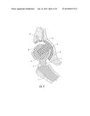 Interlocking Reverese Hip and Revision Prosthesis diagram and image