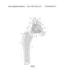 Interlocking Reverese Hip and Revision Prosthesis diagram and image